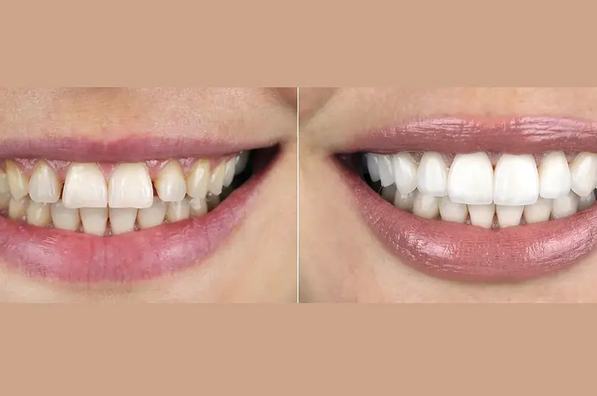Dentists Rockhampton providing cosmetic veneer consultation