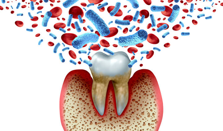 Signs and treatment of gum disease in Rockhampton CQ Dental Studio