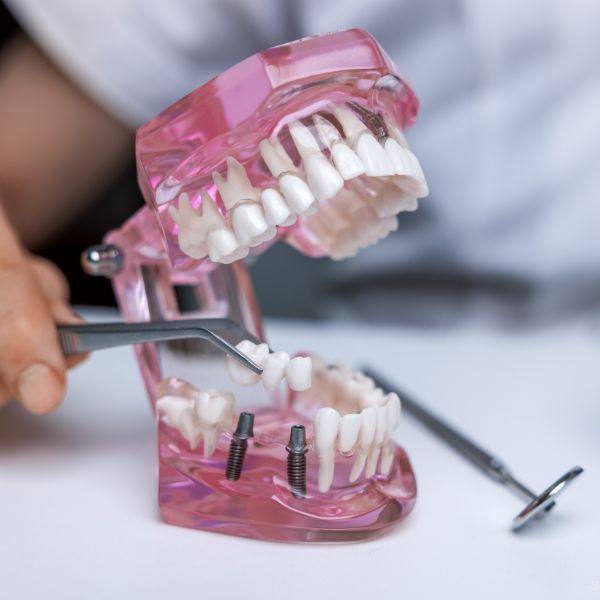 Dental Bridges Rockhampton